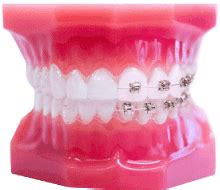 Invisible & Transparent Braces Philippines .